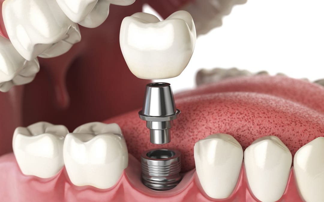 Phẫu thuật cấy ghép Implant: Giải pháp tối ưu cho người bị mất răng lâu năm  | Vinmec